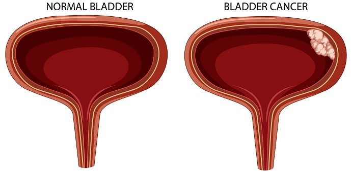 Tumors