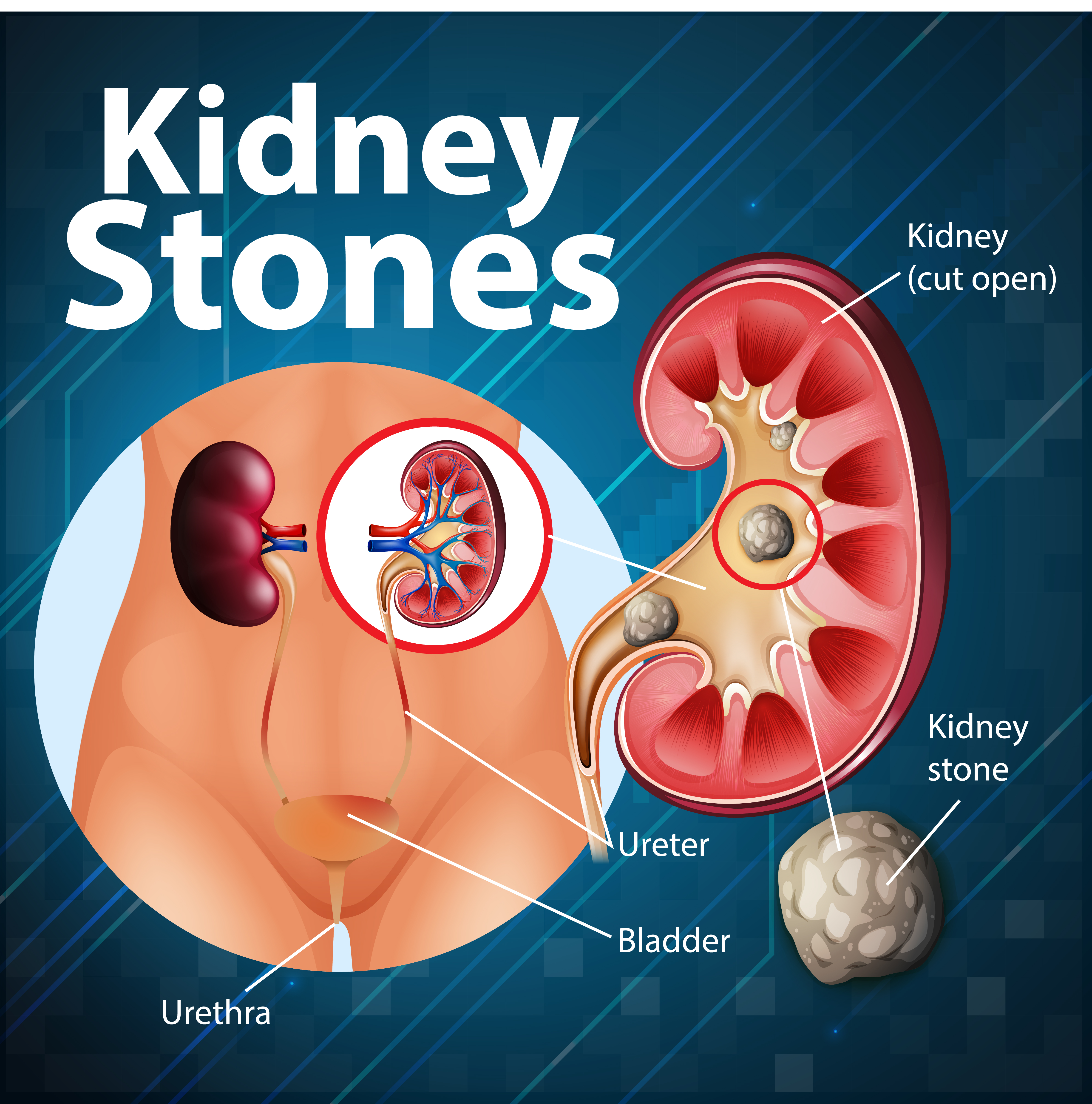 Kidney Stones